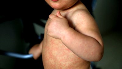 Child with measles symptoms