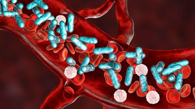 blood image for case based pediatric sepsis